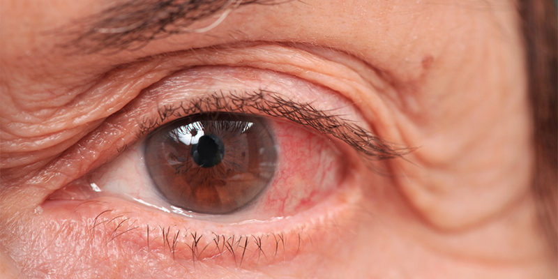 Cosa è il Glaucoma? Sintomi e cura